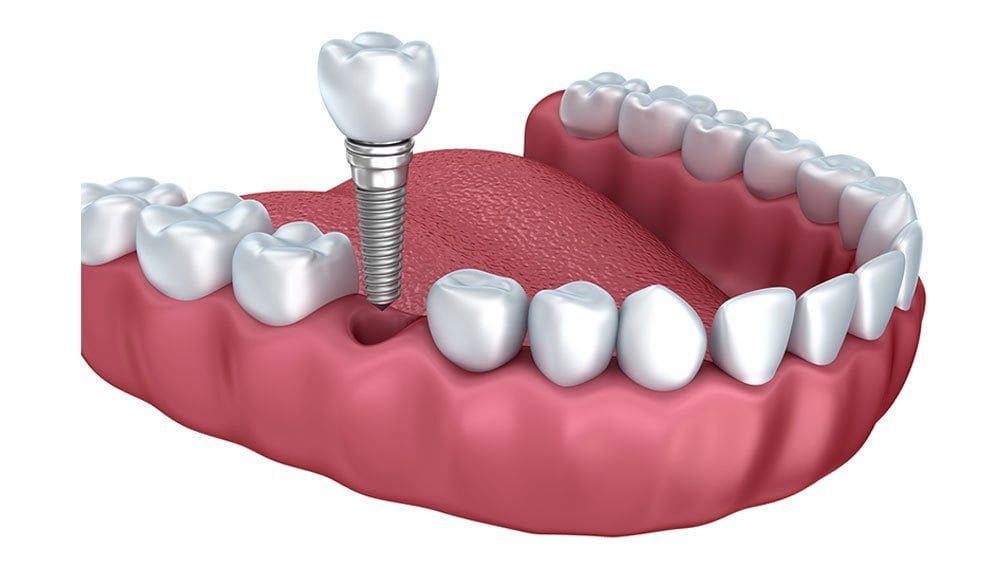 Dental Implants in Nape Dental Family, ABQ
