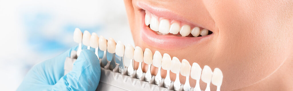 4 Questions About Dental Veneers 6