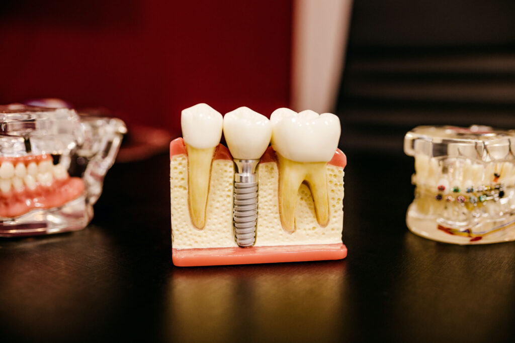 Dental Implants: Everything You Need (& want!) to Know 2